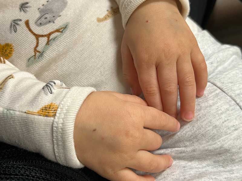 Photograph of Baby Cyrus with pin pricks in his hands